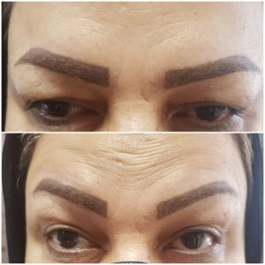 بوتاکس و ژل