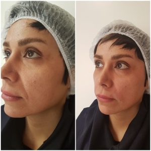 بوتاکس و ژل 10