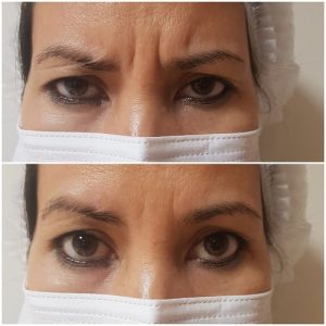 تزریق بوتاکس