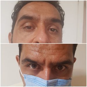 تزریق بوتاکس