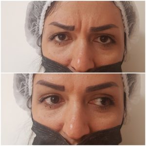 تزریق بوتاکس