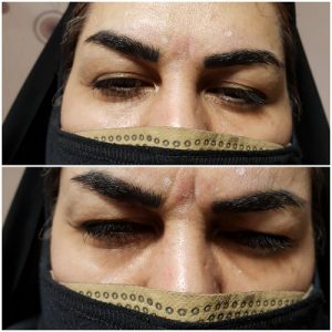 تزریق بوتاکس