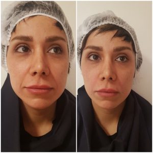 تزریق ژل