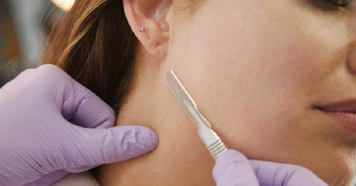 درماپلنینگ پوست