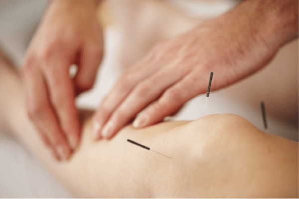 طب سوزنی در کاهش درد